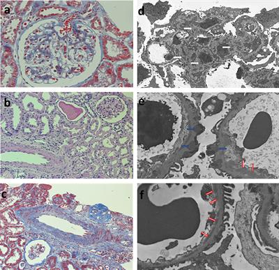 Case report: Thrombotic thrombocytopenic purpura in a pregnant woman with lupus membranous nephropathy: a diagnostic challenge